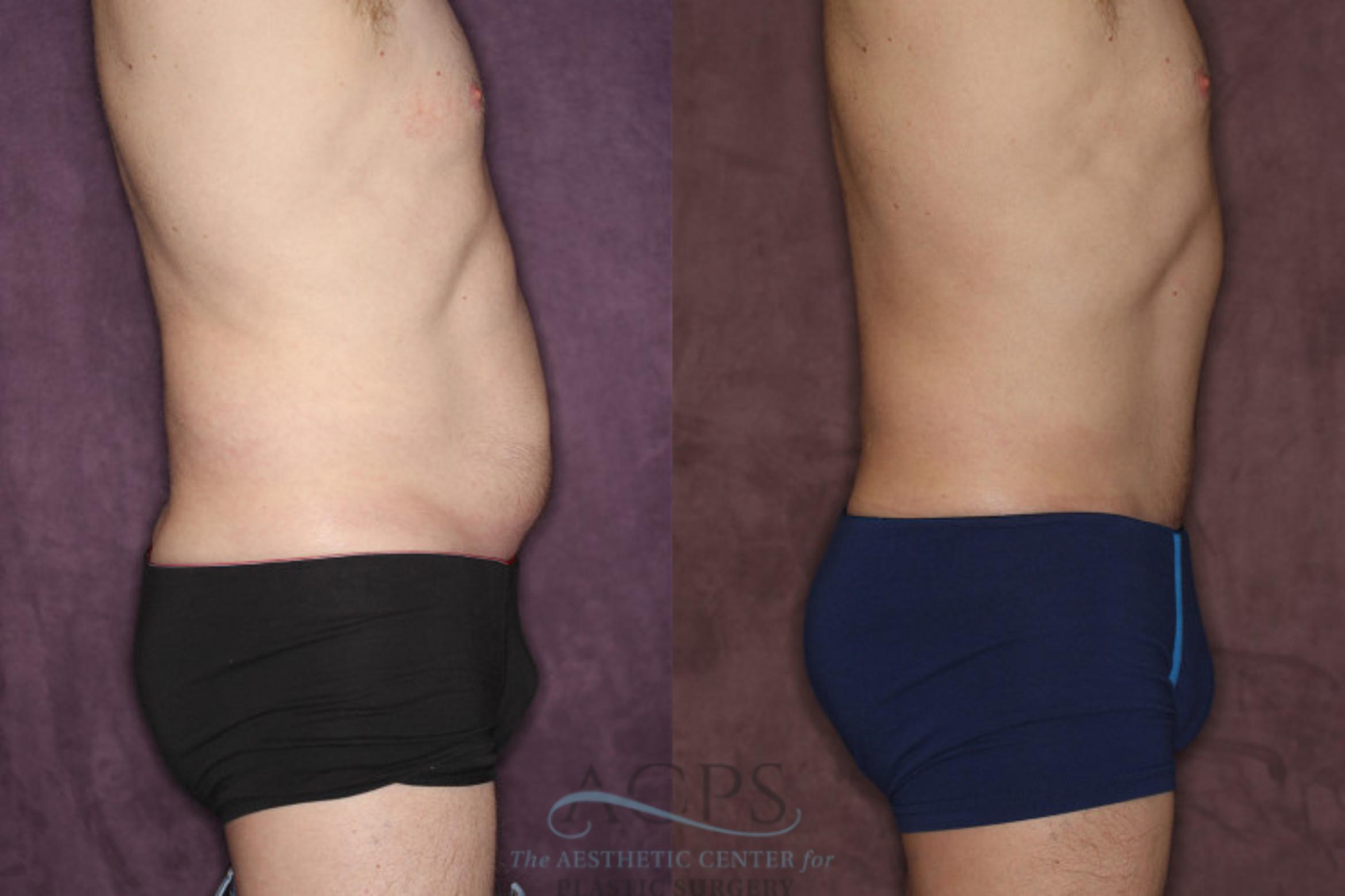 Before & After Tummy Tuck Case 19 Side Right View: View in Houston, TX