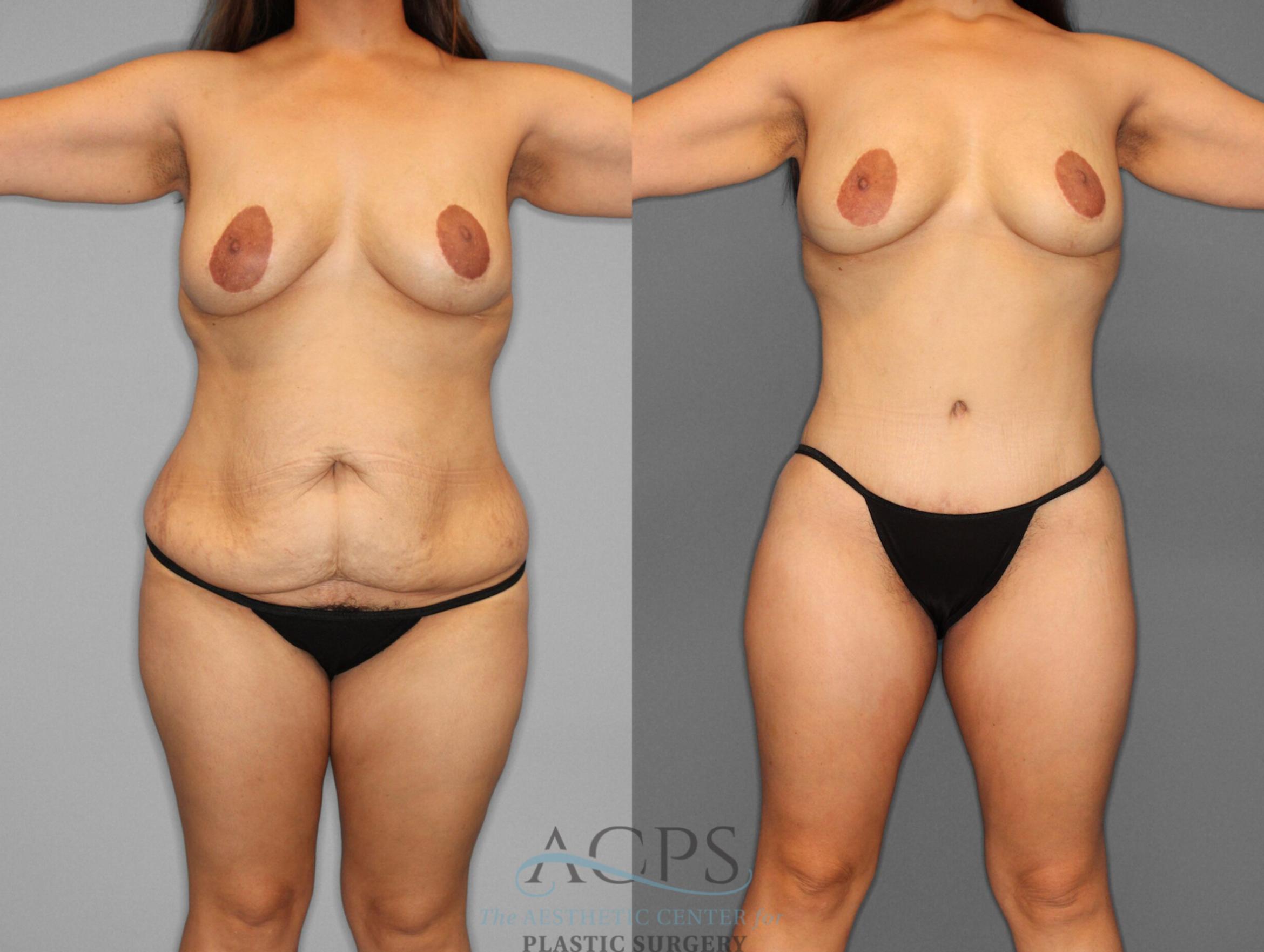 Before & After Tummy Tuck Case 2 Front View: View in Houston, TX