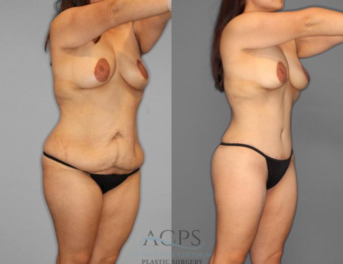 Before & After Tummy Tuck Case 2 Oblique View: View in Houston, TX