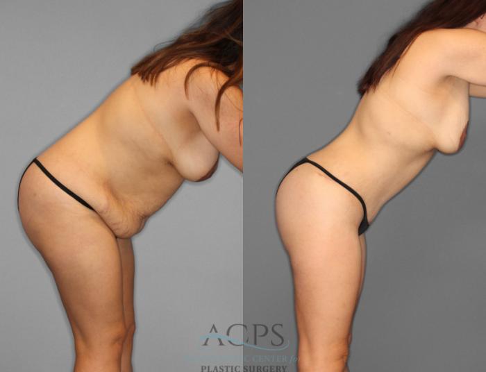 Before & After Tummy Tuck Case 2 Right Side Bend View: View in Houston, TX