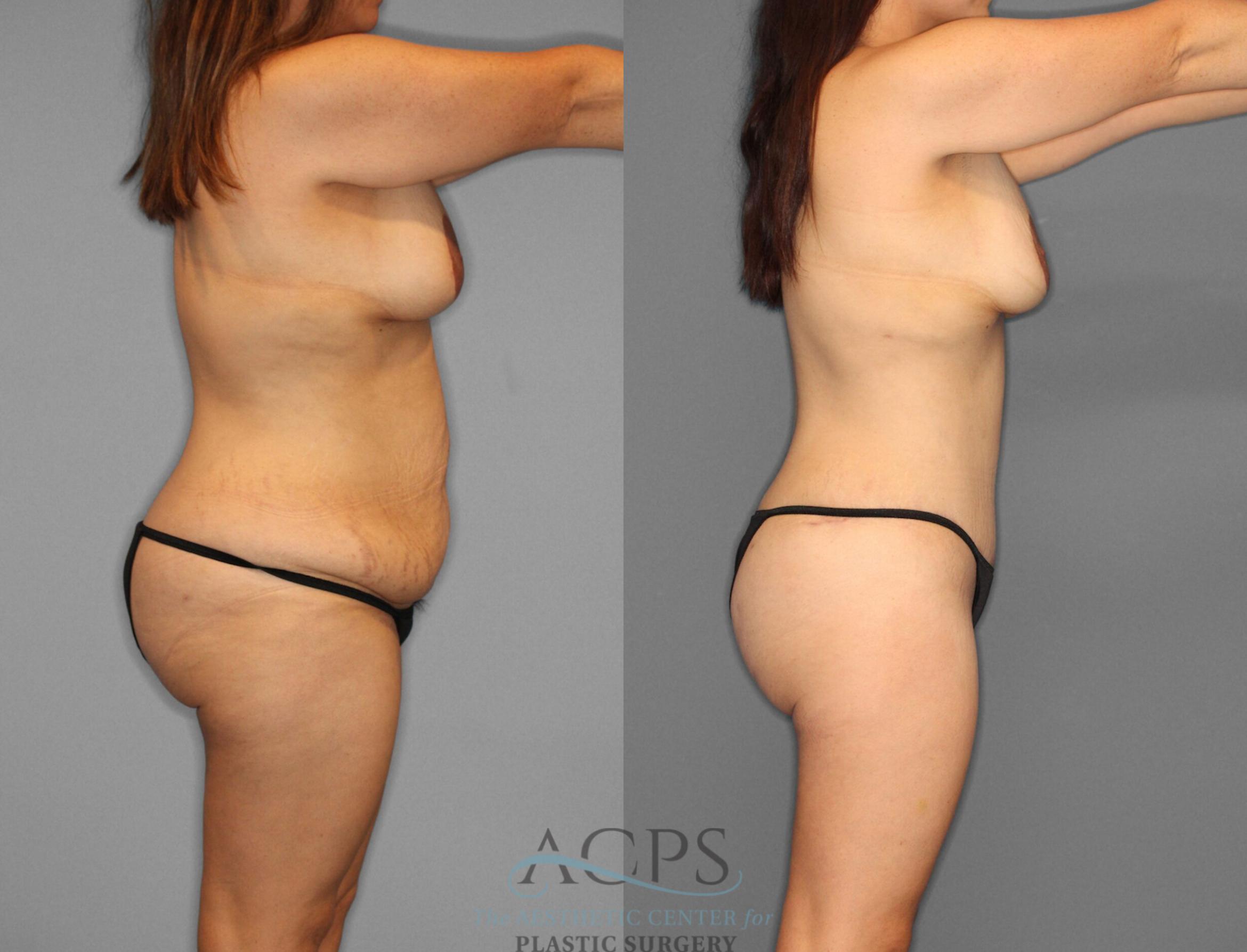 Before & After Tummy Tuck Case 2 Right Side View: View in Houston, TX