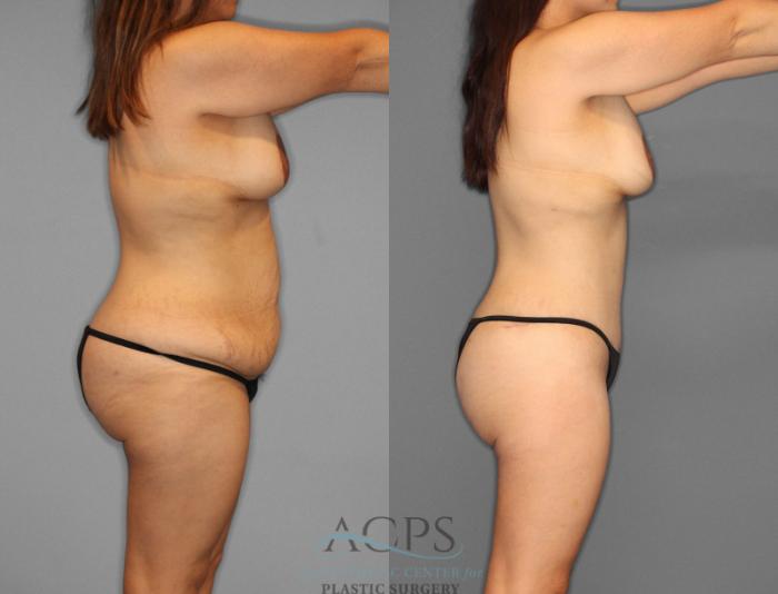 Before & After Tummy Tuck Case 2 Right Side View: View in Houston, TX