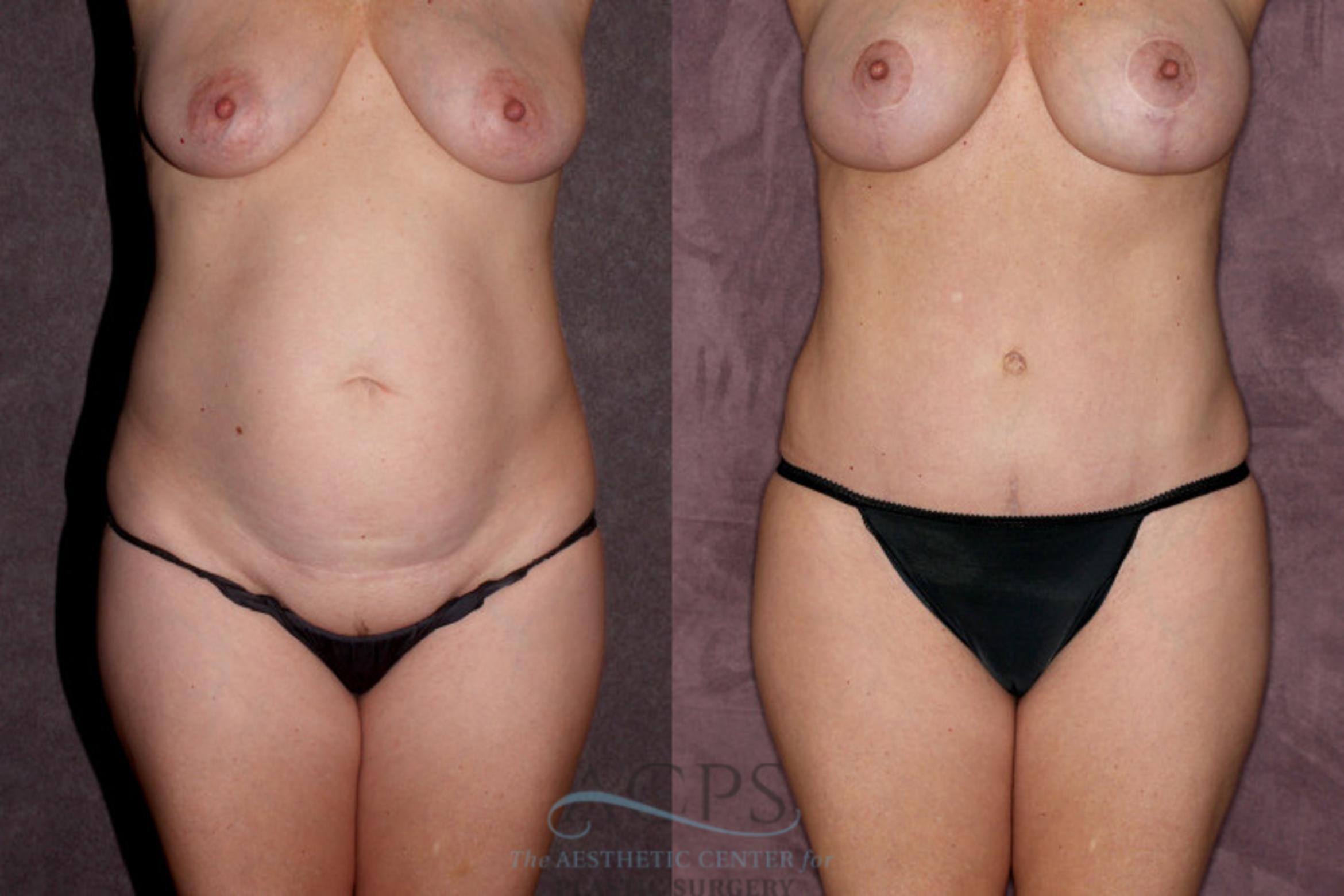 Before & After Liposuction Case 20 Front View: View in Houston, TX