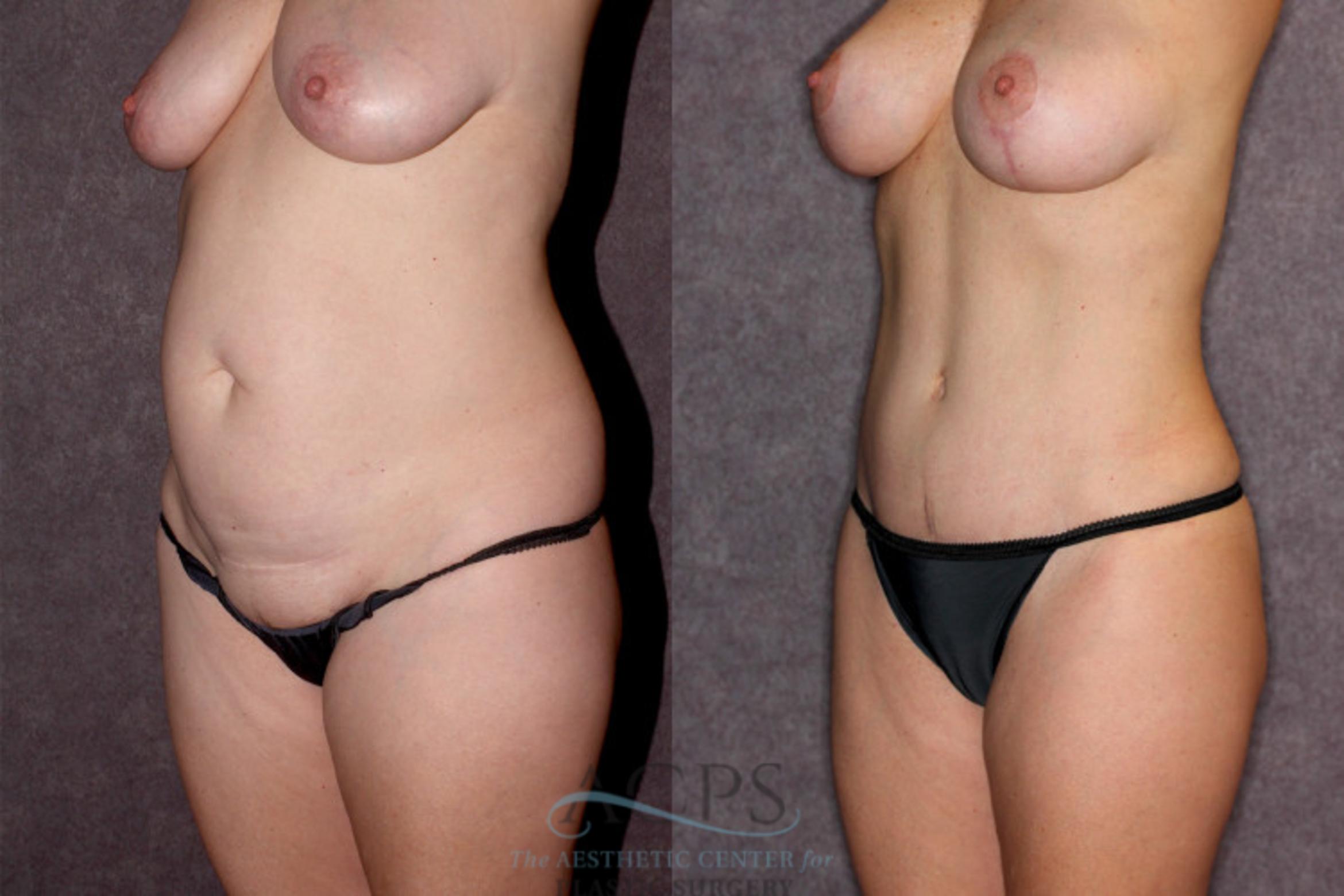 Before & After Liposuction Case 20 Oblique Left View: View in Houston, TX