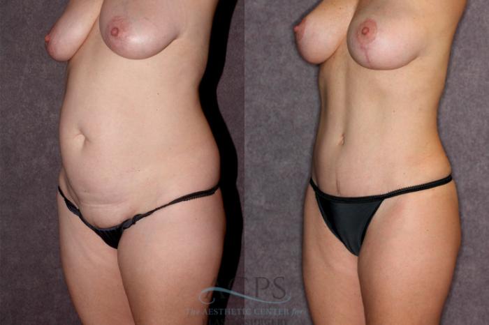 Before & After Liposuction Case 20 Oblique Left View: View in Houston, TX