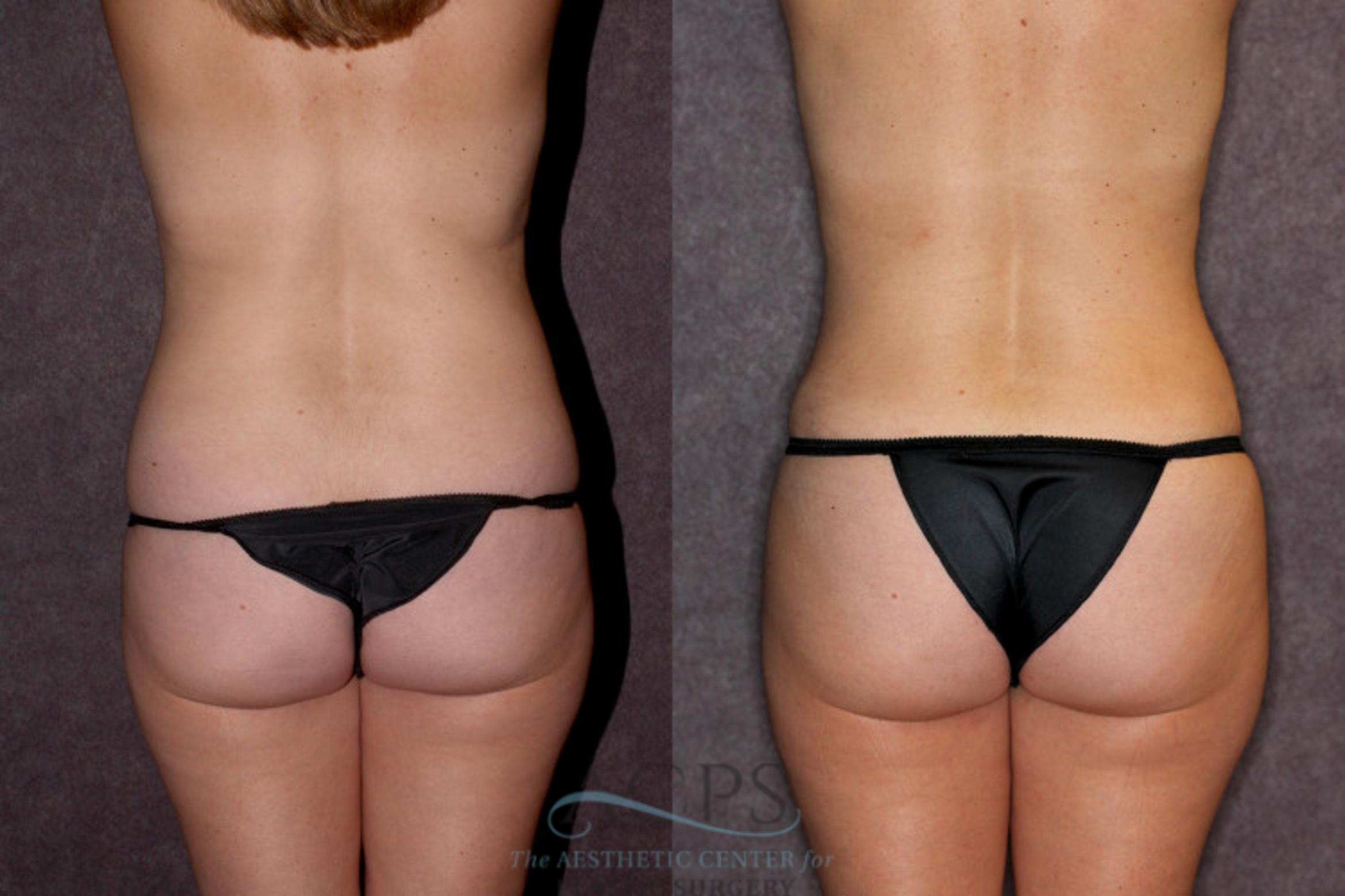 Before & After Liposuction Case 20 Rear View: View in Houston, TX
