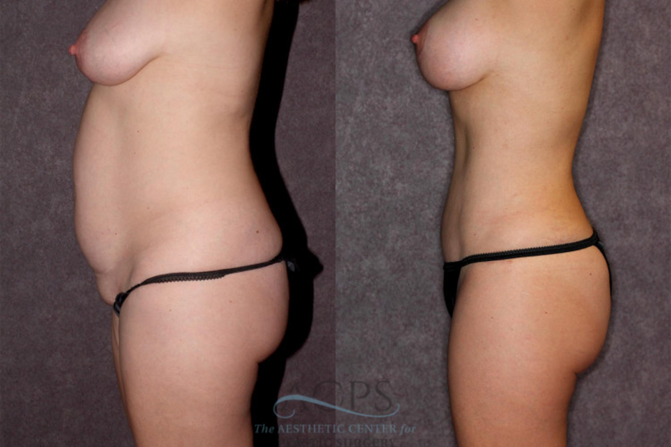Before & After Liposuction Case 20 Side Left View: View in Houston, TX