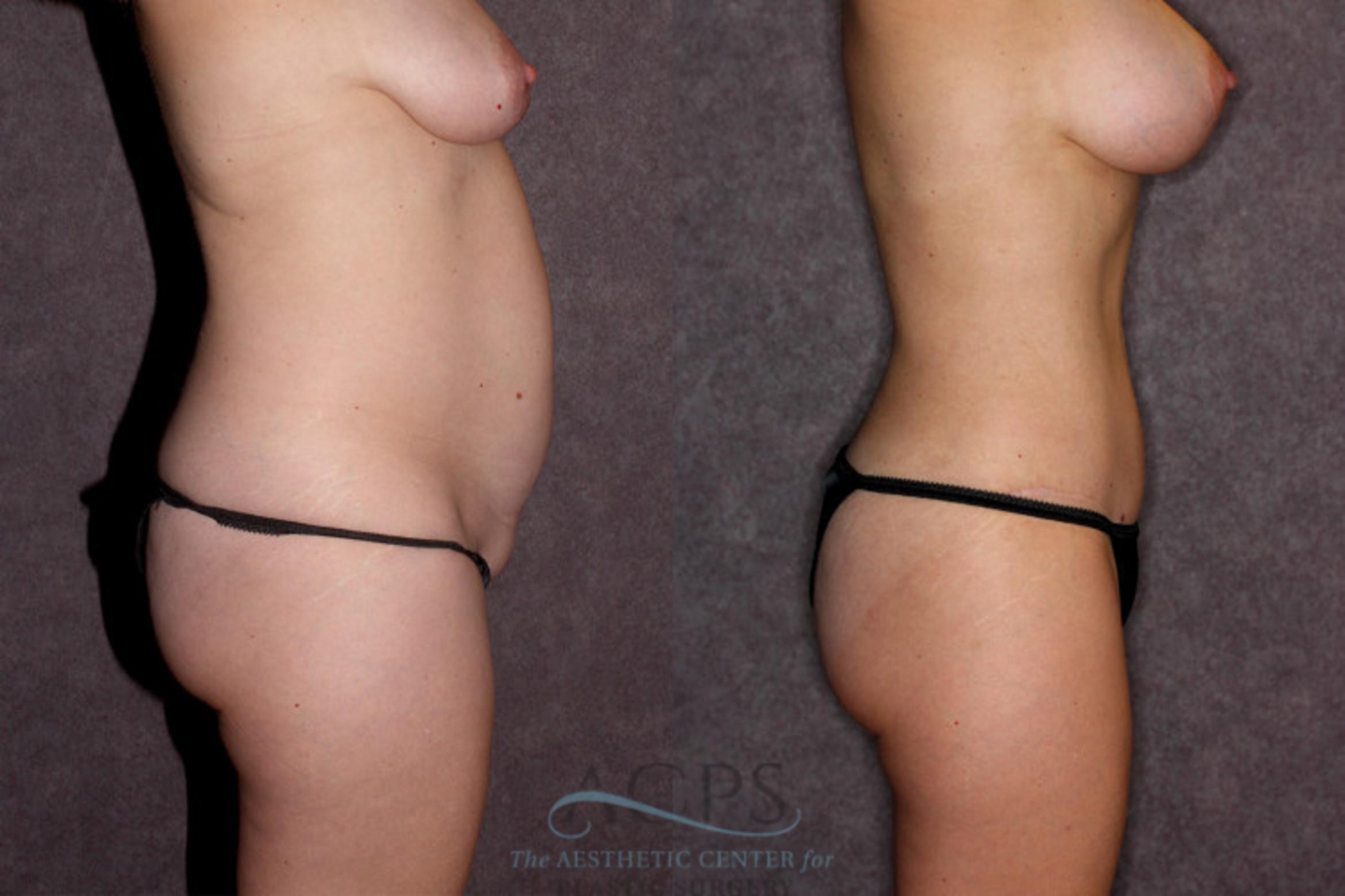 Before & After Liposuction Case 20 Side Right View: View in Houston, TX