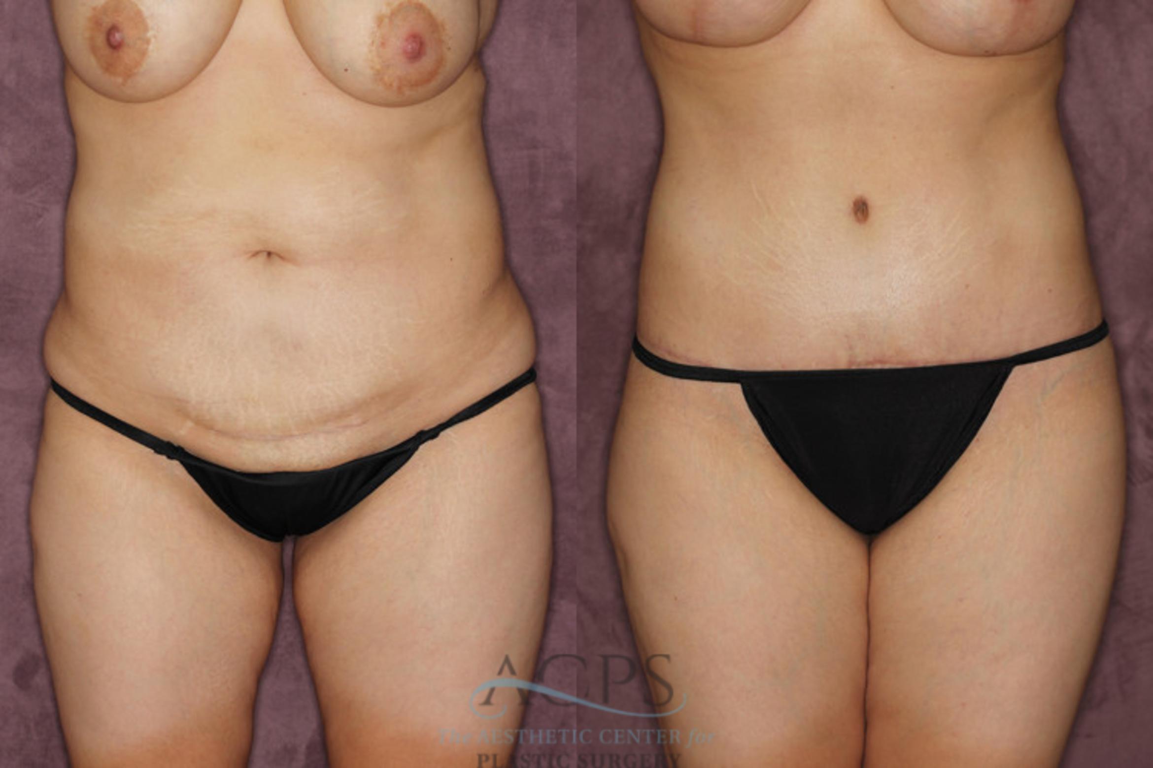 Before & After Tummy Tuck Case 21 Front View: View in Houston, TX