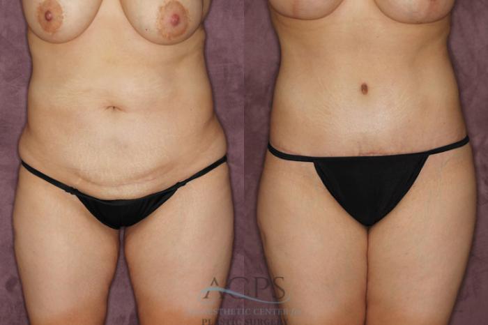Before & After Tummy Tuck Case 21 Front View: View in Houston, TX