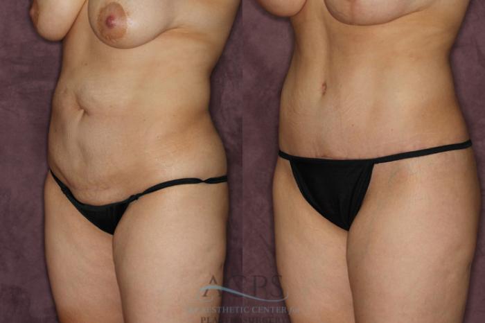 Before & After Tummy Tuck Case 21 Oblique Left View: View in Houston, TX