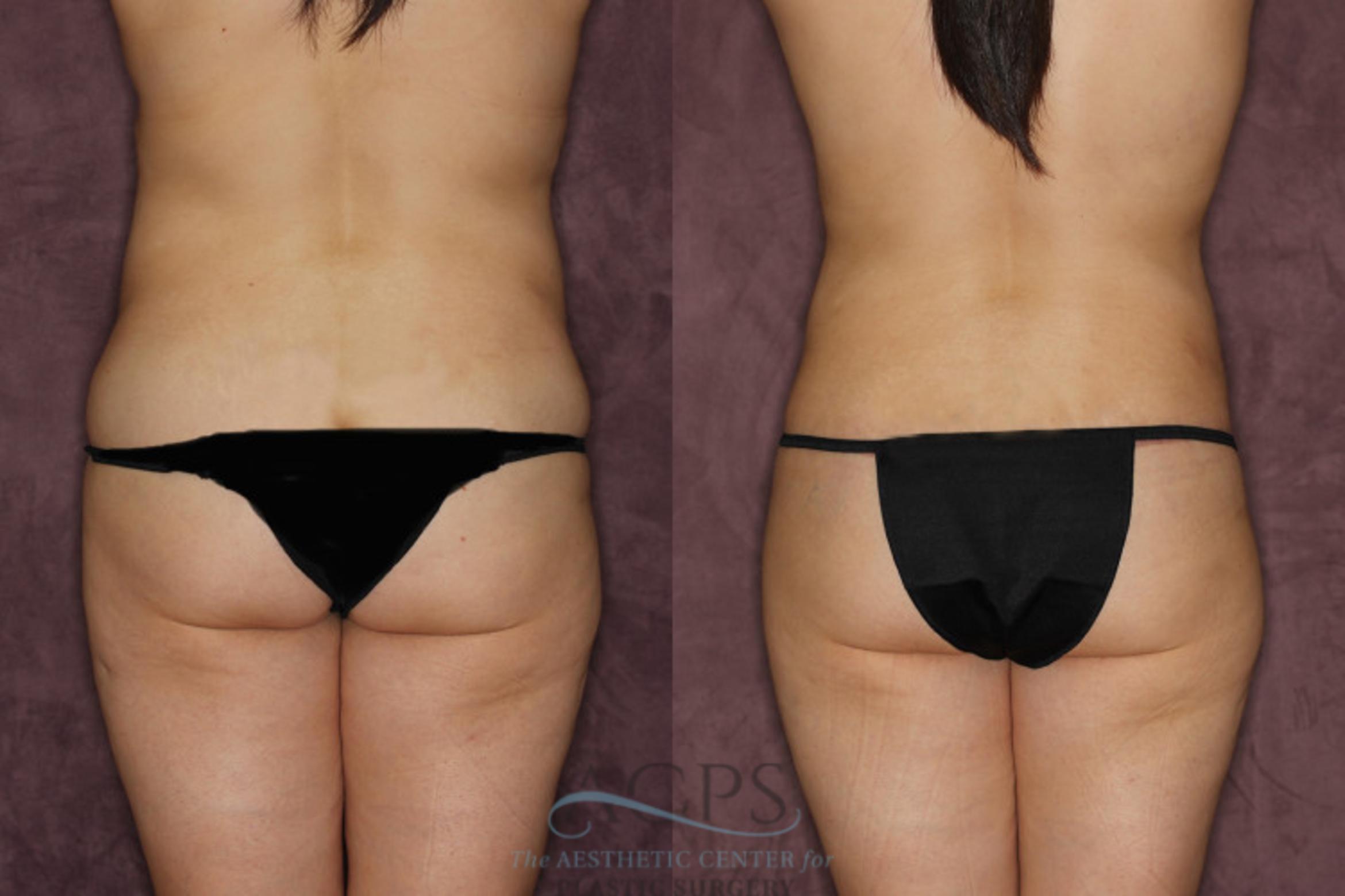 Before & After Tummy Tuck Case 21 Rear View: View in Houston, TX