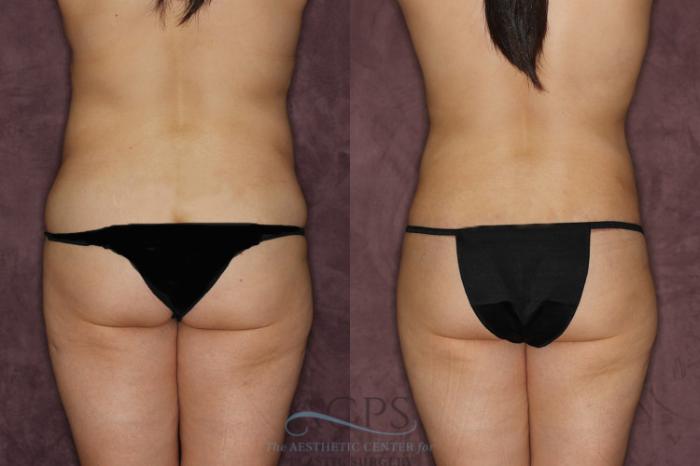 Before & After Tummy Tuck Case 21 Rear View: View in Houston, TX