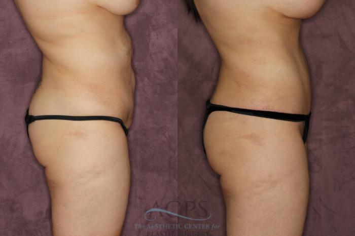 Before & After Tummy Tuck Case 21 Side Right View: View in Houston, TX