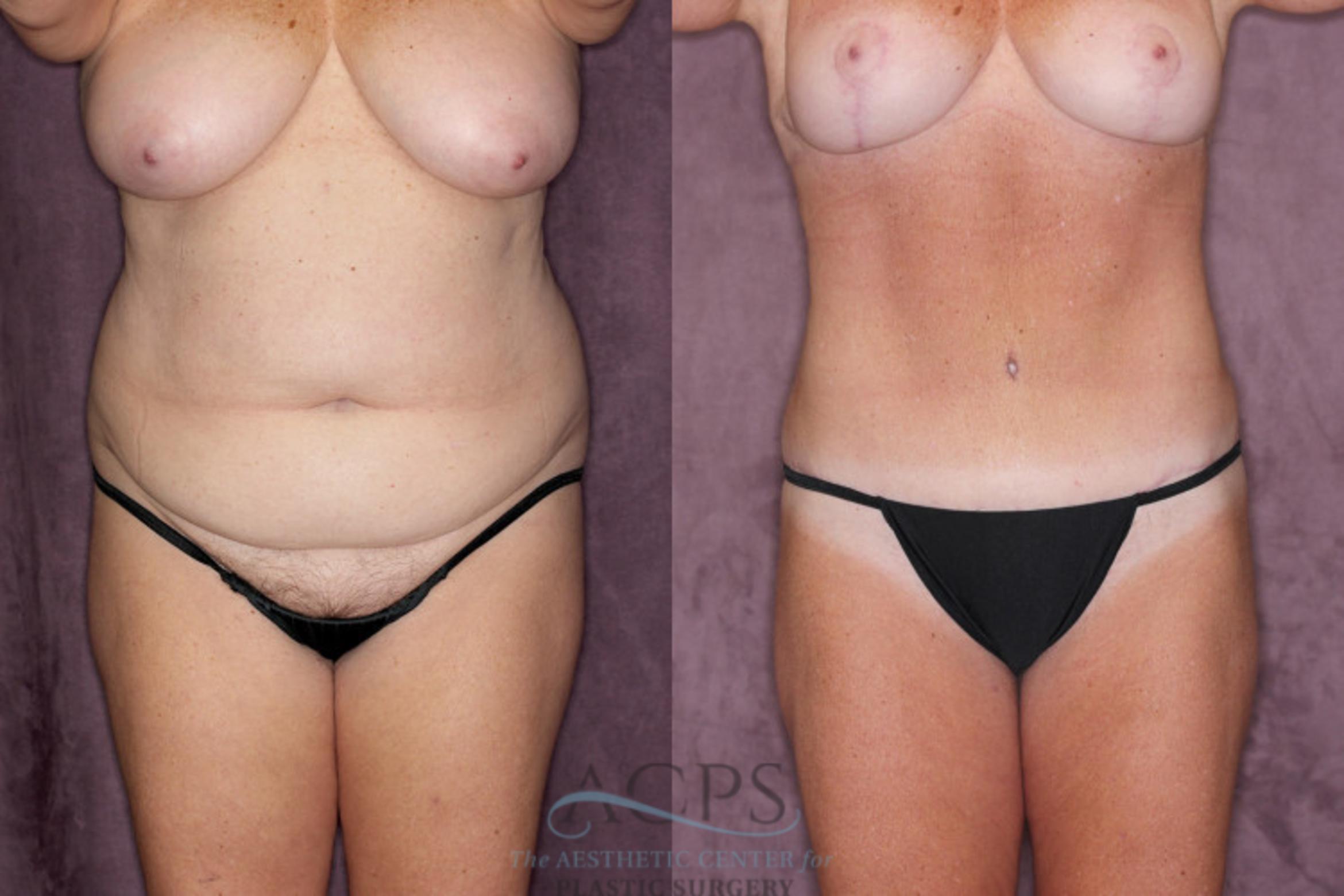 Before & After Tummy Tuck Case 22 Front View: View in Houston, TX
