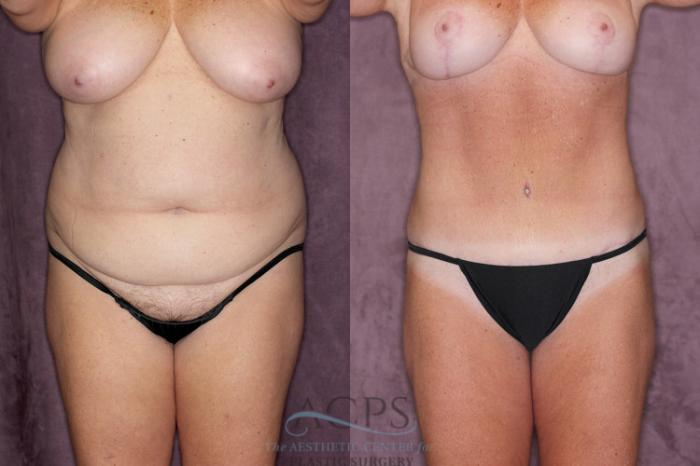 Before & After Tummy Tuck Case 22 Front View: View in Houston, TX