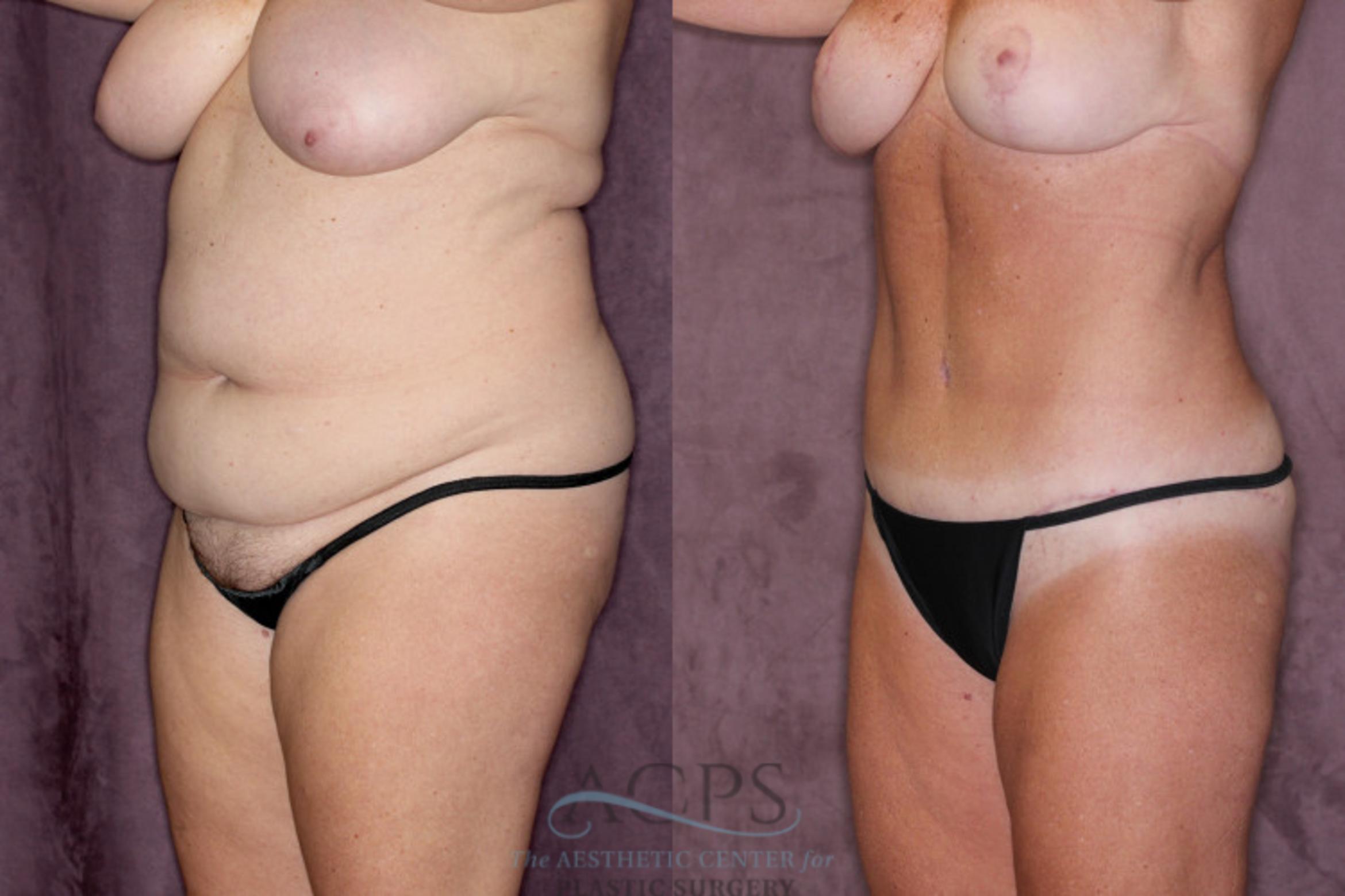 Before & After Tummy Tuck Case 22 Oblique Left View: View in Houston, TX