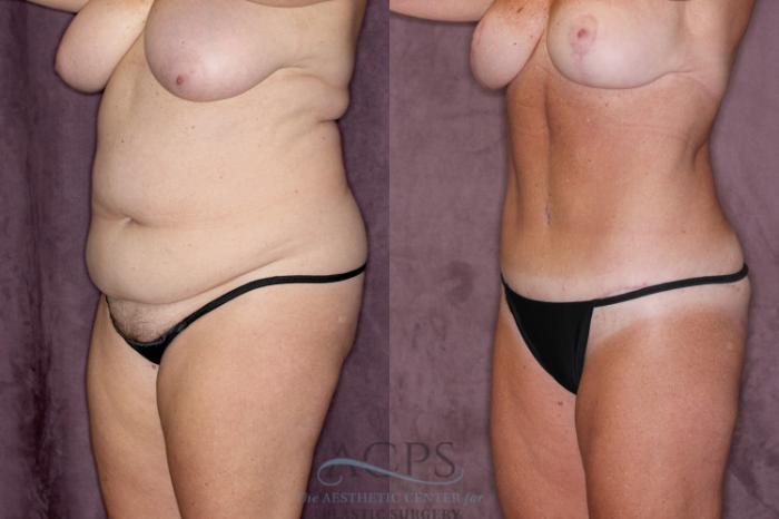 Before & After Tummy Tuck Case 22 Oblique Left View: View in Houston, TX