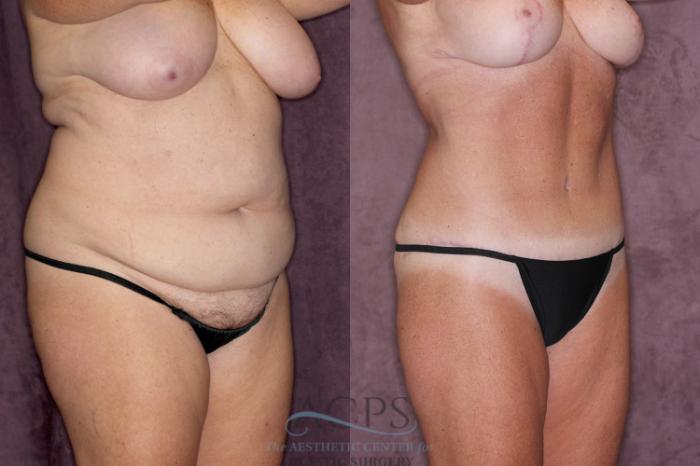 Before & After Tummy Tuck Case 22 Oblique Right View: View in Houston, TX