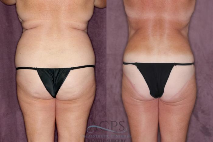 Before & After Tummy Tuck Case 22 Rear View: View in Houston, TX
