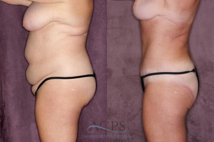 Before & After Tummy Tuck Case 22 Side Left View: View in Houston, TX