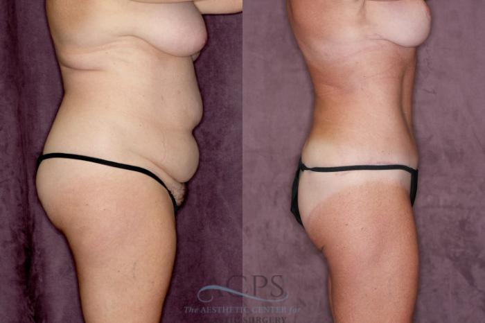Before & After Tummy Tuck Case 22 Side Right View: View in Houston, TX