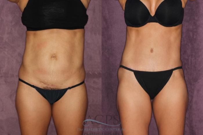 Before & After Tummy Tuck Case 23 Front View: View in Houston, TX