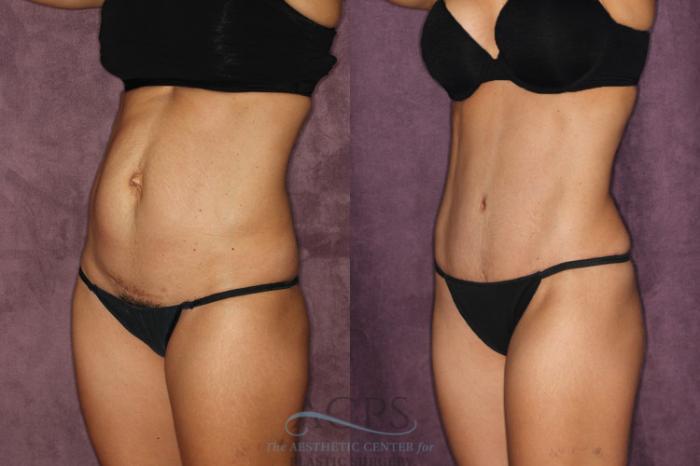 Before & After Tummy Tuck Case 23 Oblique Left View: View in Houston, TX