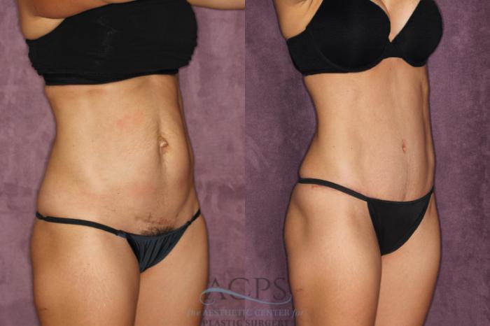 Before & After Tummy Tuck Case 23 Oblique Right View: View in Houston, TX