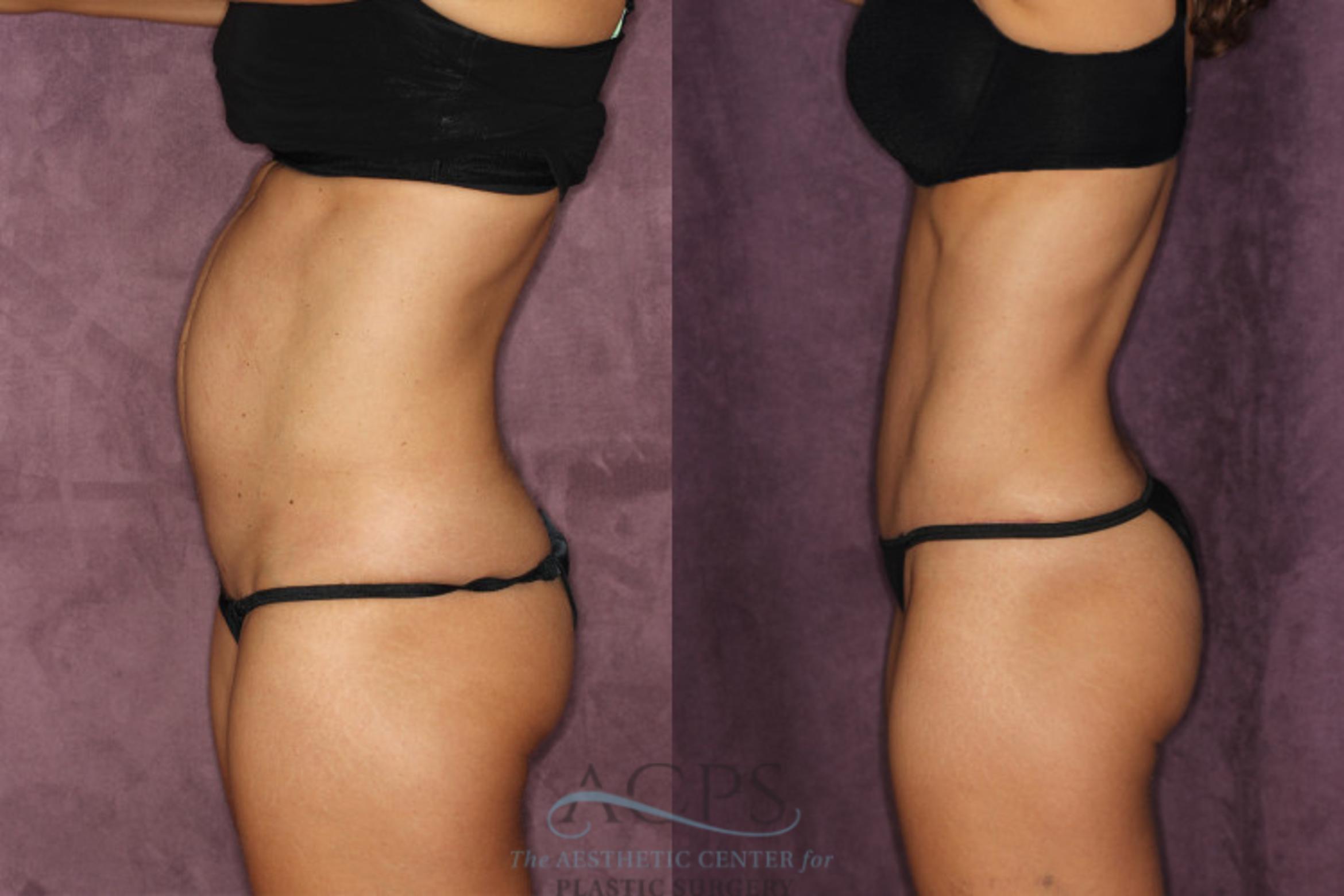 Before & After Tummy Tuck Case 23 Side Left View: View in Houston, TX