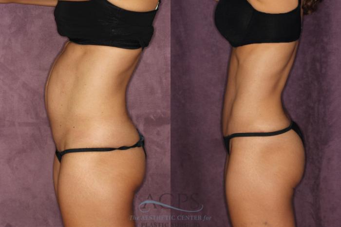 Before & After Tummy Tuck Case 23 Side Left View: View in Houston, TX