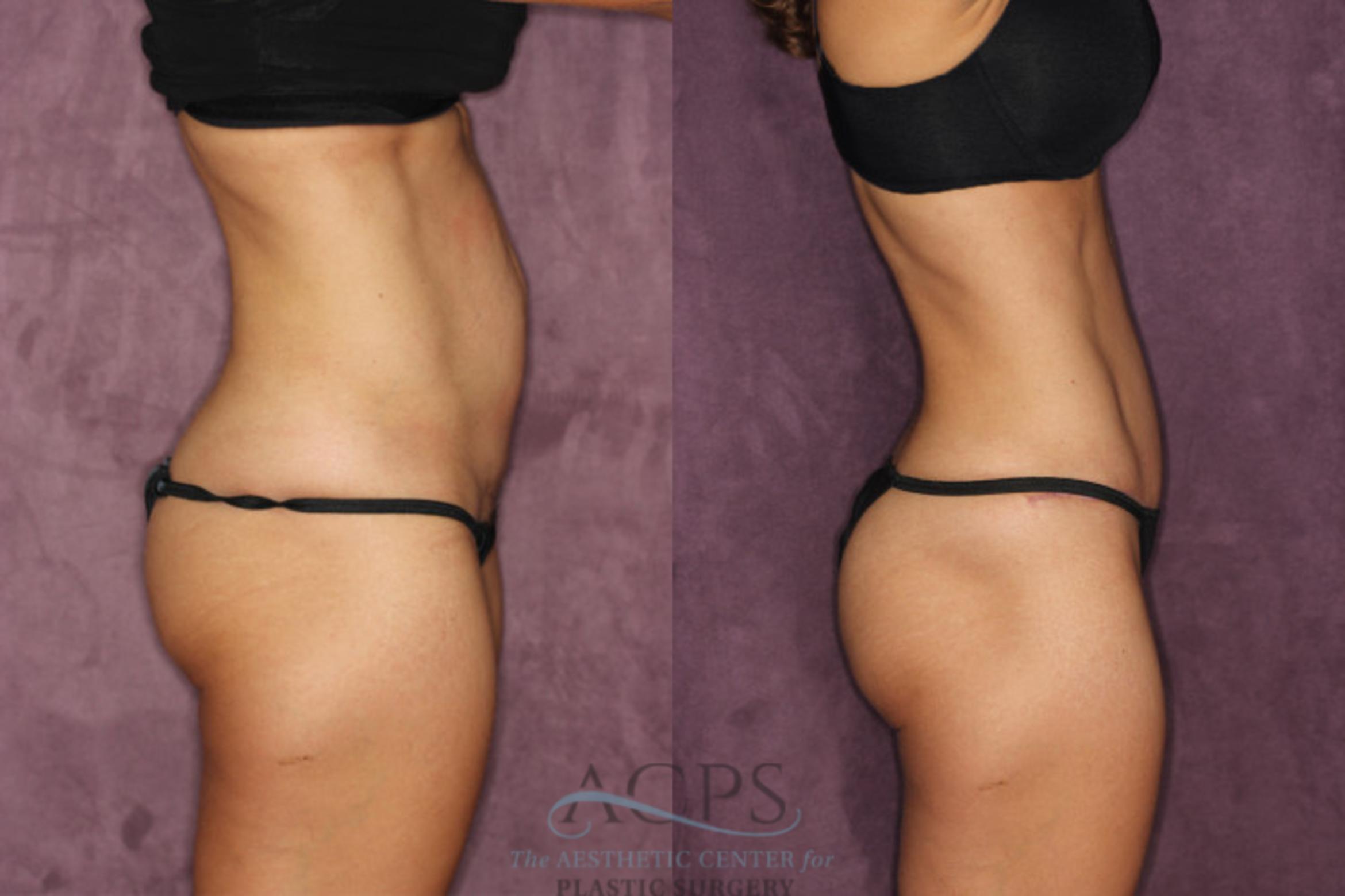 Before & After Tummy Tuck Case 23 Side Right View: View in Houston, TX