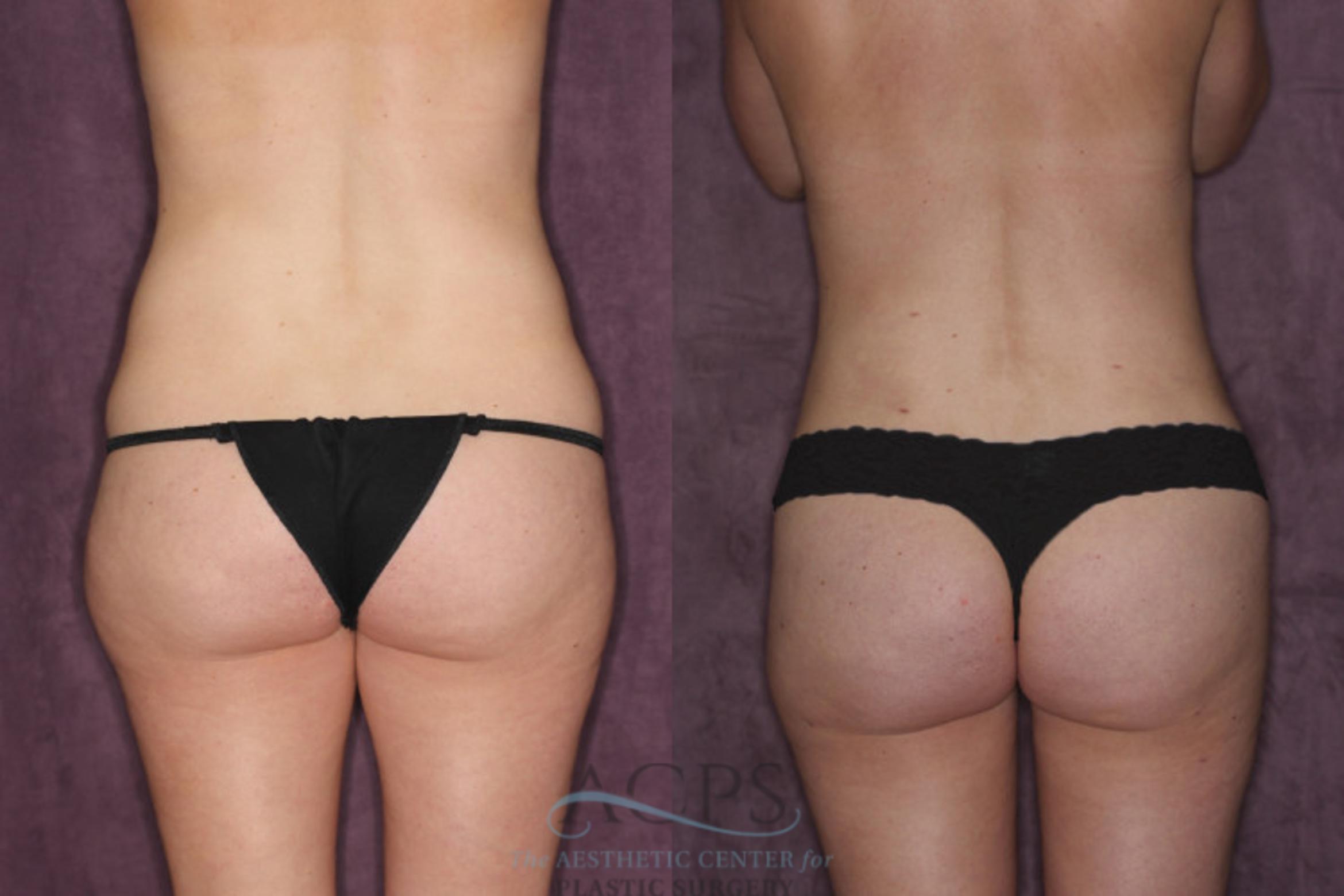 Before & After Tummy Tuck Case 24 Rear View: View in Houston, TX