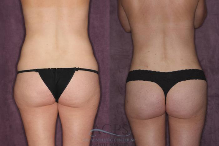 Before & After Tummy Tuck Case 24 Rear View: View in Houston, TX