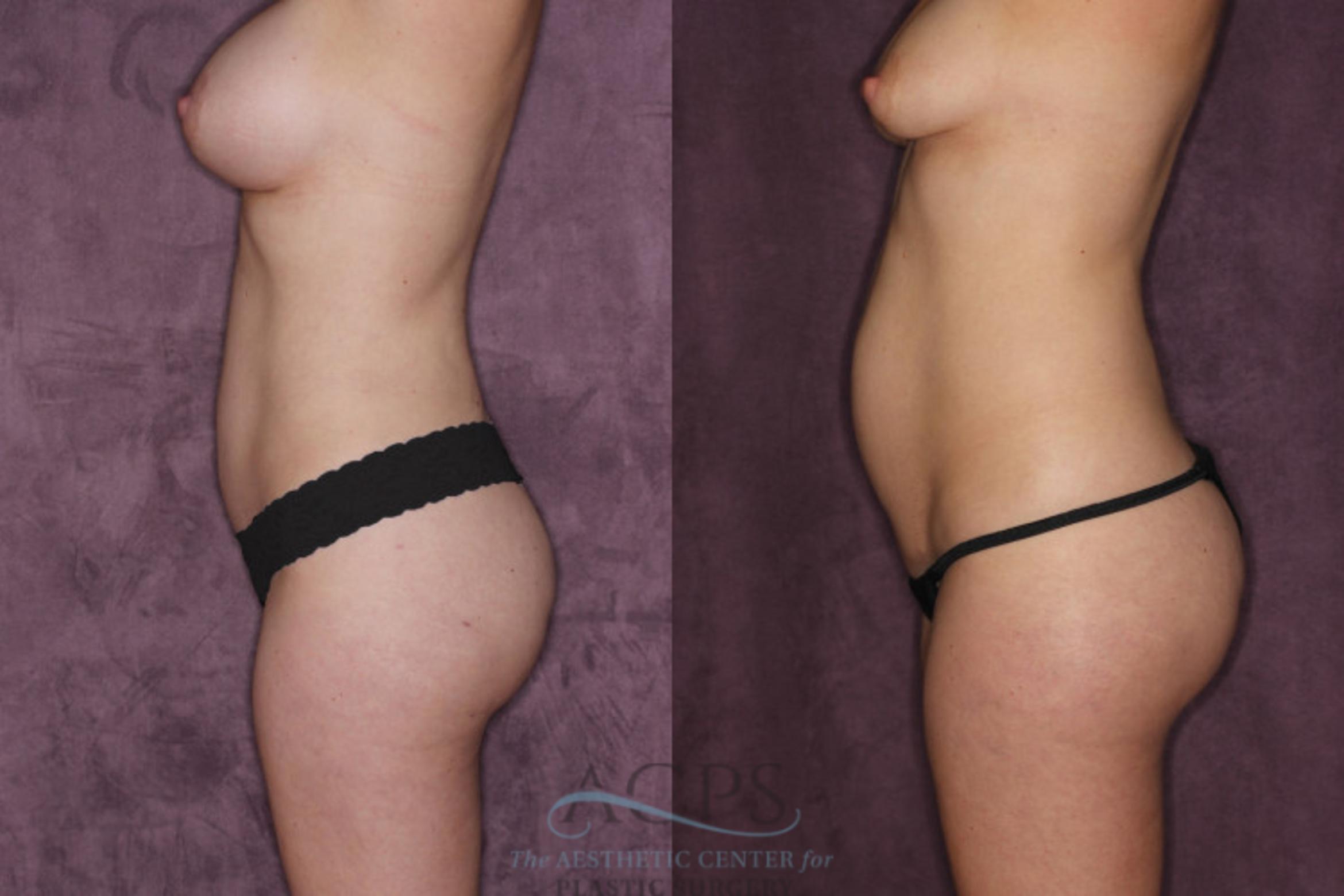 Before & After Tummy Tuck Case 24 Side Left View: View in Houston, TX