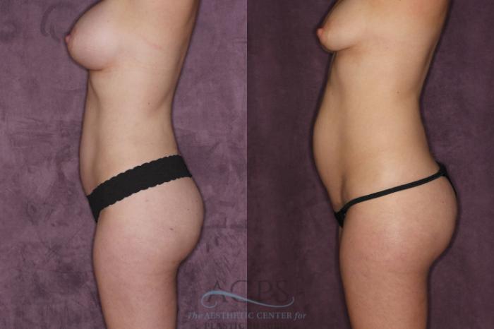 Before & After Tummy Tuck Case 24 Side Left View: View in Houston, TX