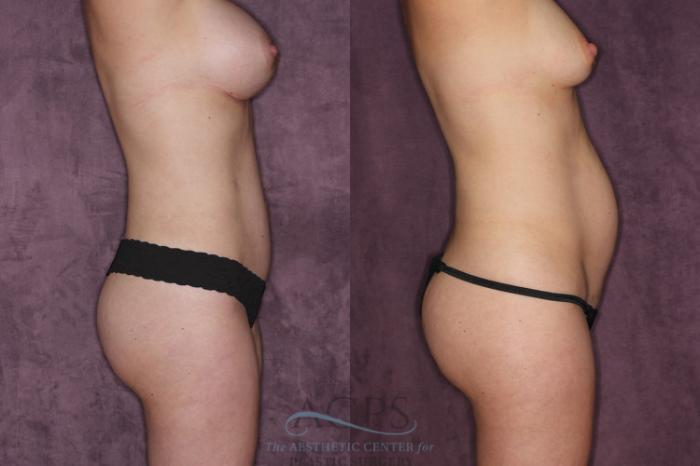 Before & After Tummy Tuck Case 24 Side Right View: View in Houston, TX