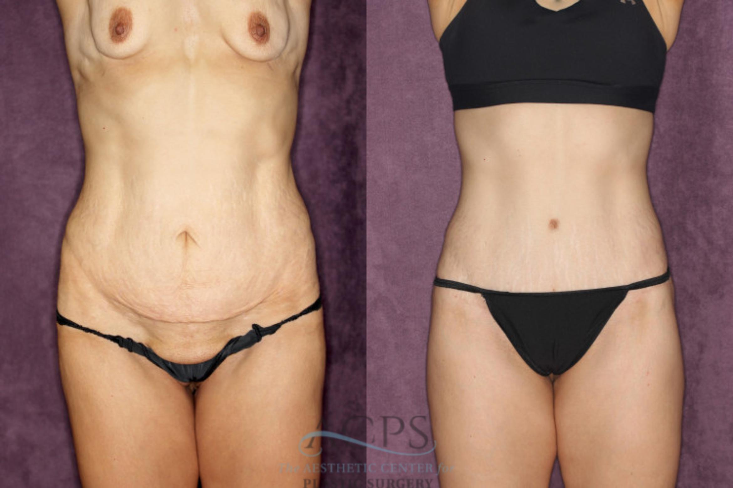 Before & After Body Lift Case 25 Front View: View in Houston, TX