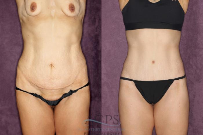 Before & After Body Lift Case 25 Front View: View in Houston, TX