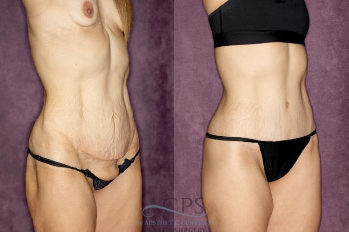 Before & After Body Lift Case 25 Oblique Right View: View in Houston, TX