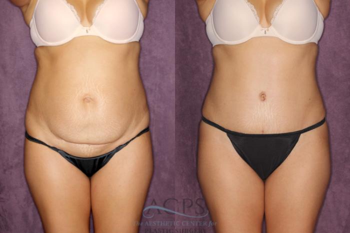 Before & After Liposuction Case 26 Front View: View in Houston, TX