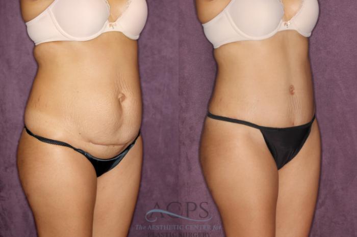 Before & After Liposuction Case 26 Oblique Right View: View in Houston, TX