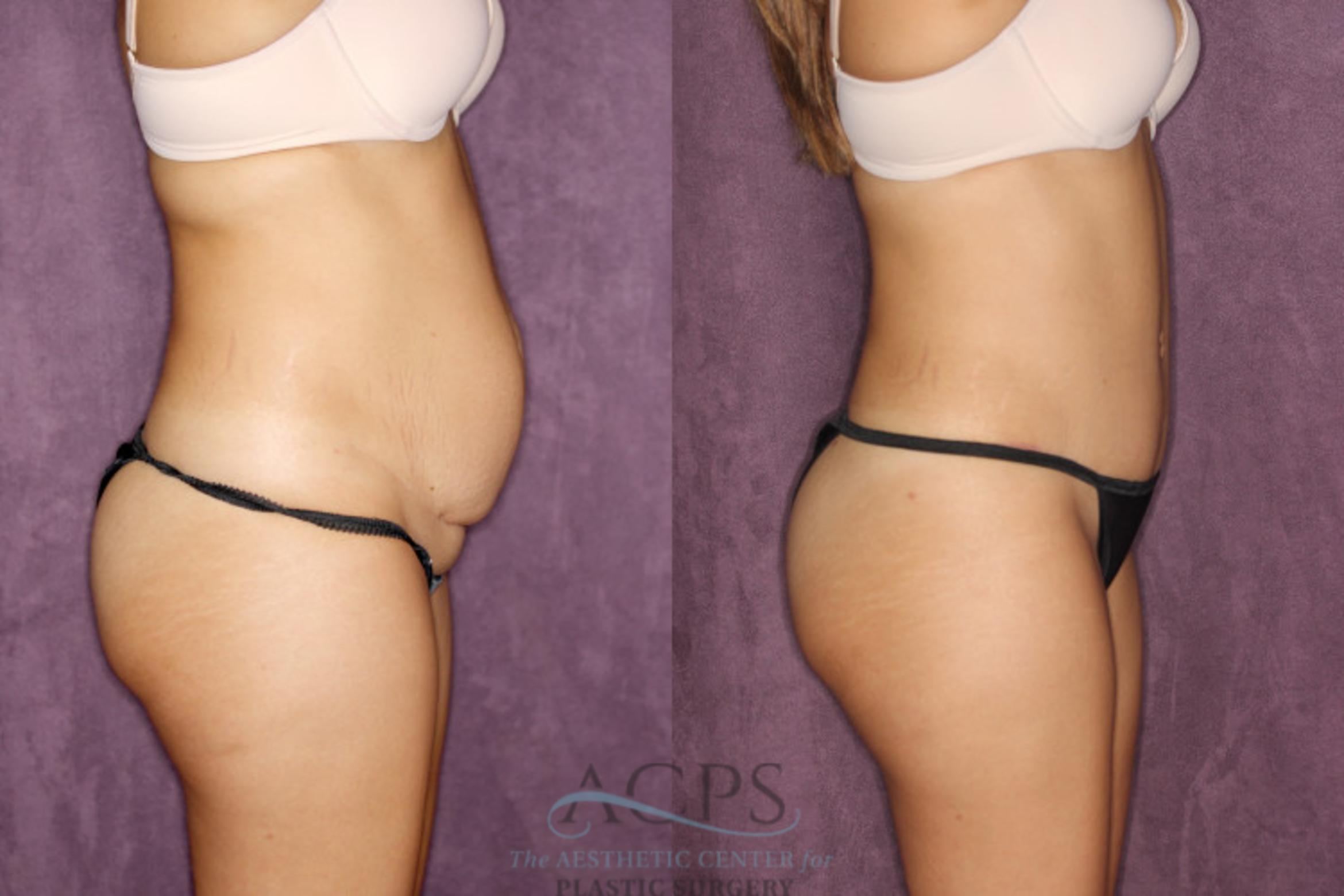 Before & After Liposuction Case 26 Side Right View: View in Houston, TX