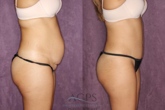 Before & After Liposuction Case 26 Side Right View: View in Houston, TX