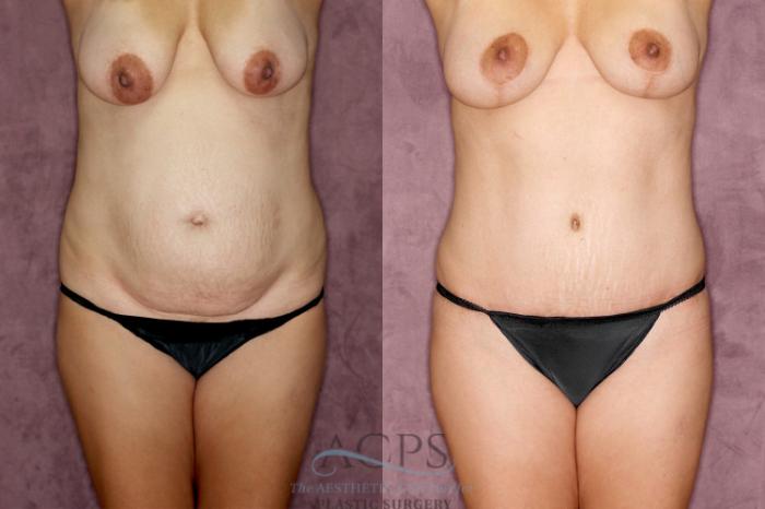 Before & After Tummy Tuck Case 28 Front View: View in Houston, TX