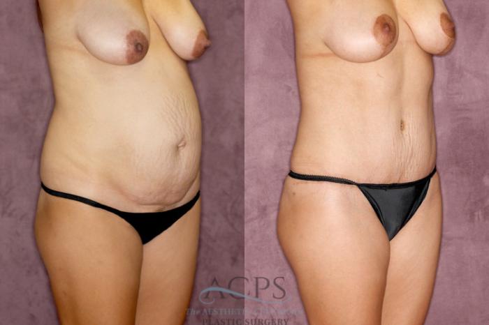 Before & After Tummy Tuck Case 28 Oblique Right View: View in Houston, TX