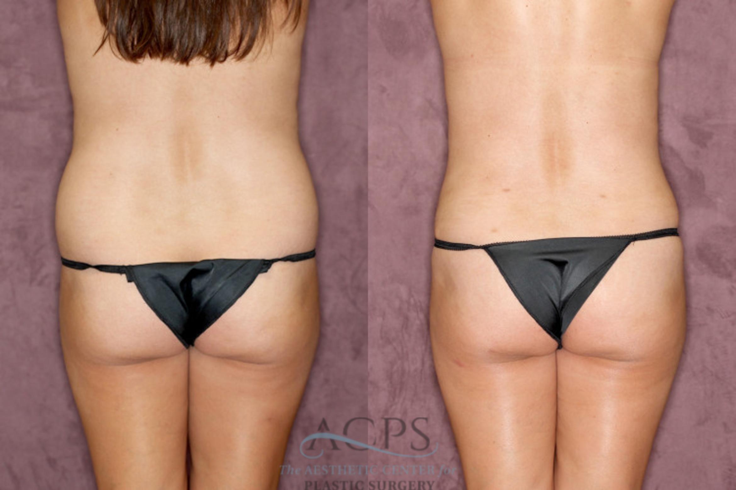 Before & After Tummy Tuck Case 28 Rear View: View in Houston, TX