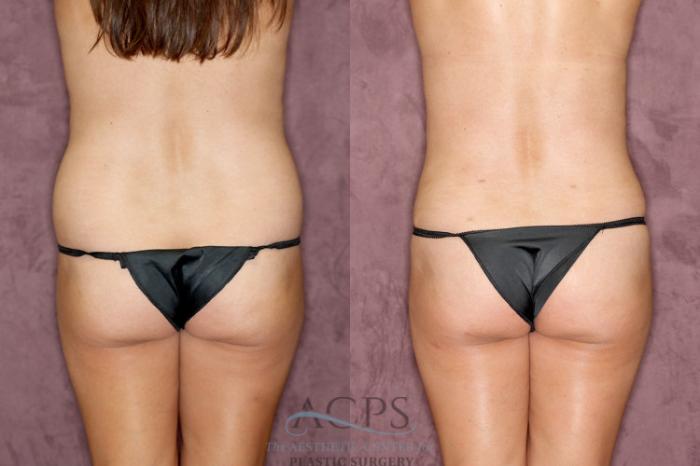 Before & After Tummy Tuck Case 28 Rear View: View in Houston, TX