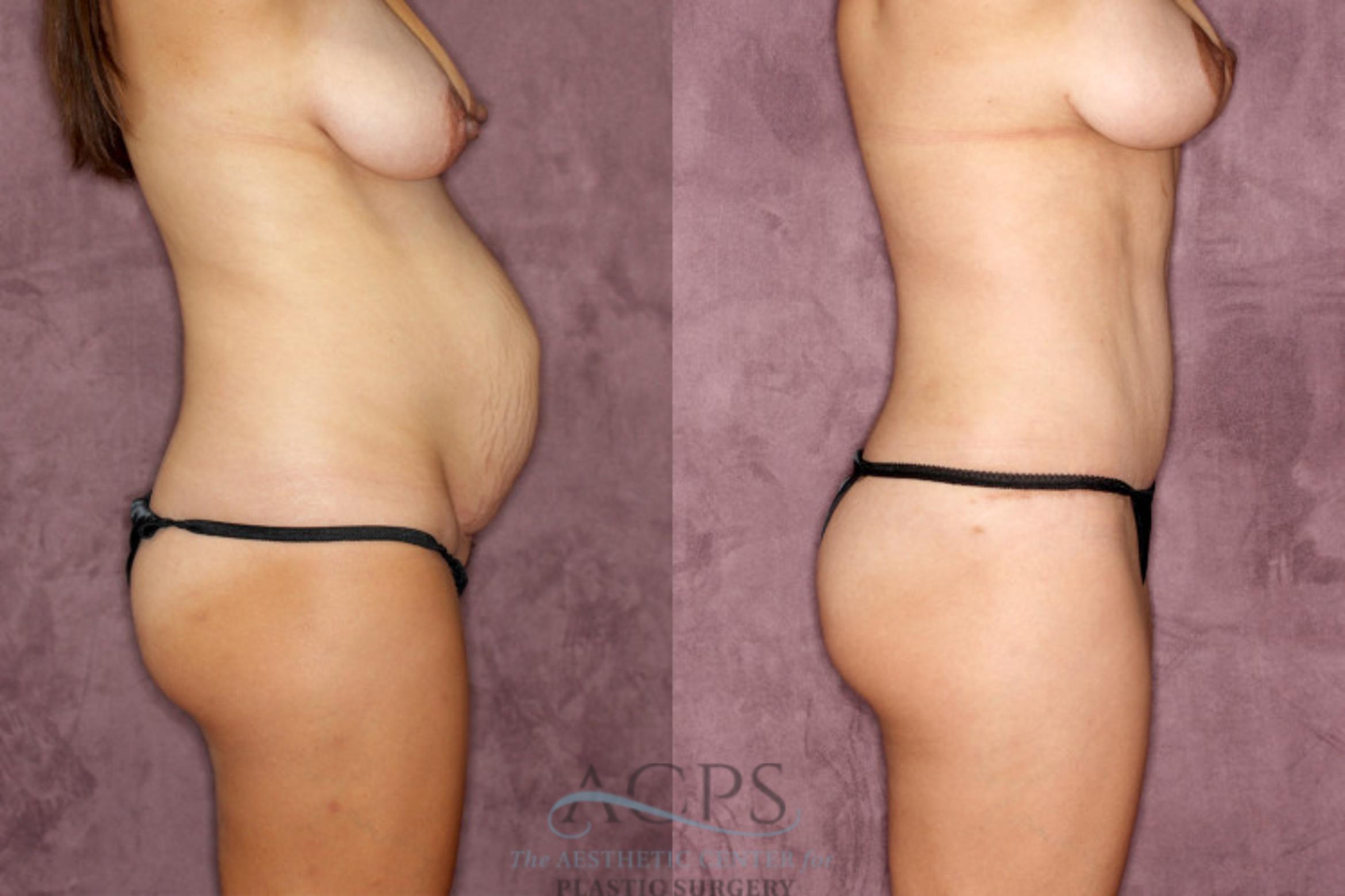 Before & After Tummy Tuck Case 28 Side Right View: View in Houston, TX