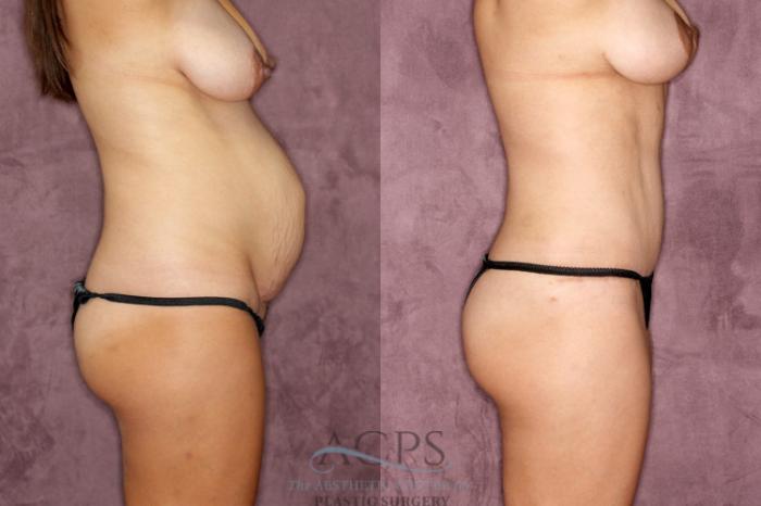 Before & After Tummy Tuck Case 28 Side Right View: View in Houston, TX